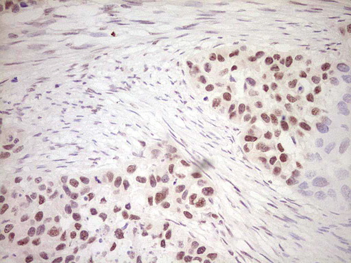 DVL2 / Dishevelled 2 Antibody - Immunohistochemical staining of paraffin-embedded Carcinoma of Human kidney tissue using anti-DVL2 mouse monoclonal antibody. (Heat-induced epitope retrieval by 1 mM EDTA in 10mM Tris, pH8.5, 120C for 3min,