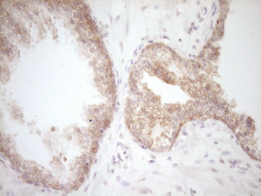 DVL2 / Dishevelled 2 Antibody - Immunohistochemical staining of paraffin-embedded Carcinoma of Human prostate tissue using anti-DVL2 mouse monoclonal antibody. (Heat-induced epitope retrieval by 1 mM EDTA in 10mM Tris, pH8.5, 120C for 3min,
