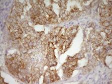 DVL2 / Dishevelled 2 Antibody - Immunohistochemical staining of paraffin-embedded Adenocarcinoma of Human endometrium tissue using anti-DVL2 mouse monoclonal antibody. (Heat-induced epitope retrieval by 1 mM EDTA in 10mM Tris, pH8.5, 120C for 3min,