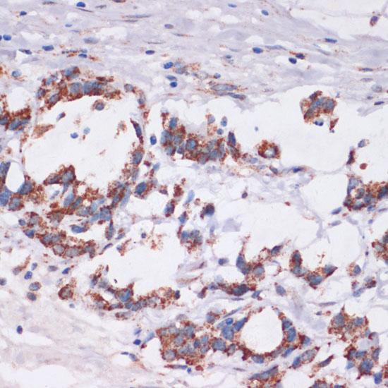 DVL2 / Dishevelled 2 Antibody - Immunohistochemistry of paraffin-embedded Human gastric cancer using DVL2 Polyclonal Antibody at dilution of 1:100 (40x lens).