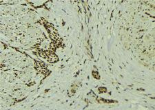 DXO / DOM3Z Antibody - 1:100 staining human breast carcinoma tissue by IHC-P. The sample was formaldehyde fixed and a heat mediated antigen retrieval step in citrate buffer was performed. The sample was then blocked and incubated with the antibody for 1.5 hours at 22°C. An HRP conjugated goat anti-rabbit antibody was used as the secondary.