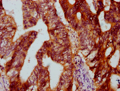 DYM Antibody - Immunohistochemistry Dilution at 1:500 and staining in paraffin-embedded human colon cancer performed on a Leica BondTM system. After dewaxing and hydration, antigen retrieval was mediated by high pressure in a citrate buffer (pH 6.0). Section was blocked with 10% normal Goat serum 30min at RT. Then primary antibody (1% BSA) was incubated at 4°C overnight. The primary is detected by a biotinylated Secondary antibody and visualized using an HRP conjugated SP system.