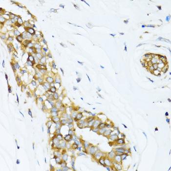 Dynactin 2 / Dynamitin Antibody - Immunohistochemistry of paraffin-embedded Human breast cancer using DCTN2 Polyclonal Antibody at dilution of 1:100 (40x lens).