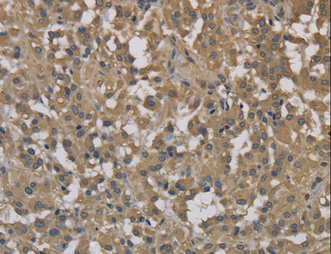 Dynactin 3 / DCTN3 Antibody - Immunohistochemistry of paraffin-embedded Human cervical cancer using DCTN3 Polyclonal Antibody at dilution of 1:70.