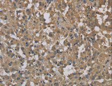 Dynactin 3 / DCTN3 Antibody - Immunohistochemistry of paraffin-embedded Human cervical cancer using DCTN3 Polyclonal Antibody at dilution of 1:70.