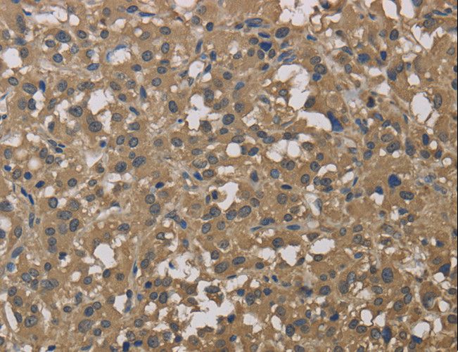 Dynactin 3 / DCTN3 Antibody - Immunohistochemistry of paraffin-embedded Human cervical cancer using DCTN3 Polyclonal Antibody at dilution of 1:50.