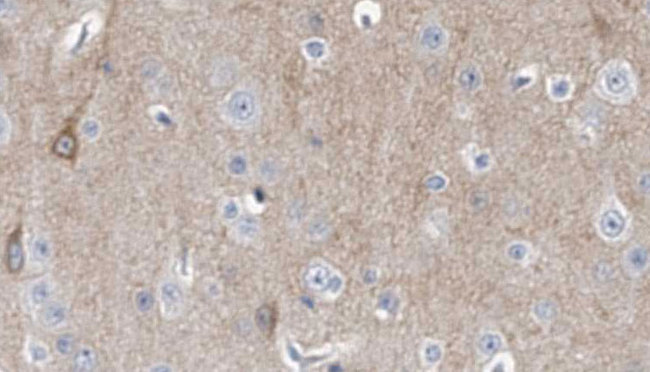 Dynactin 3 / DCTN3 Antibody - 1:100 staining human brain carcinoma tissue by IHC-P. The sample was formaldehyde fixed and a heat mediated antigen retrieval step in citrate buffer was performed. The sample was then blocked and incubated with the antibody for 1.5 hours at 22°C. An HRP conjugated goat anti-rabbit antibody was used as the secondary.