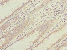 DYNC1I1 Antibody - Immunohistochemistry of paraffin-embedded human colon cancer at dilution of 1:100