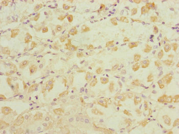 DYNC1I1 Antibody - Immunohistochemistry of paraffin-embedded human gastric cancer at dilution of 1:100
