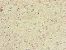 DYNC2LI1 / D2LIC Antibody - Immunohistochemistry of paraffin-embedded human glioma cancer at dilution of 1:100