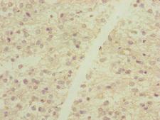 DYNC2LI1 / D2LIC Antibody - Immunohistochemistry of paraffin-embedded human glioma cancer at dilution of 1:100