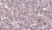 DYNC2LI1 / D2LIC Antibody - 1:100 staining human pancreas carcinoma tissue by IHC-P. The sample was formaldehyde fixed and a heat mediated antigen retrieval step in citrate buffer was performed. The sample was then blocked and incubated with the antibody for 1.5 hours at 22°C. An HRP conjugated goat anti-rabbit antibody was used as the secondary.