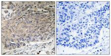 DYNLL2 Antibody - Immunohistochemistry analysis of paraffin-embedded human lung carcinoma tissue, using DYNLL2 Antibody. The picture on the right is blocked with the synthesized peptide.