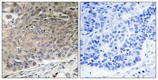 DYNLL2 Antibody - Peptide - + Immunohistochemistry analysis of paraffin-embedded human lung carcinoma tissue using DYNLL2 antibody.