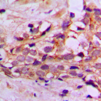 DYNLL2 Antibody - Immunohistochemical analysis of DYNLL2 staining in human breast cancer formalin fixed paraffin embedded tissue section. The section was pre-treated using heat mediated antigen retrieval with sodium citrate buffer (pH 6.0). The section was then incubated with the antibody at room temperature and detected using an HRP conjugated compact polymer system. DAB was used as the chromogen. The section was then counterstained with hematoxylin and mounted with DPX.