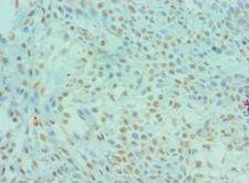 DYRK2 Antibody - Immunohistochemistry of paraffin-embedded human colon cancer using antibody 1:100 dilution.