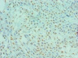 DYRK2 Antibody - Immunohistochemistry of paraffin-embedded human breast cancer using DYRK2 Antibody at dilution of 1:100