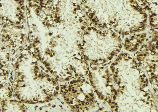 DYX1C1 Antibody - 1:100 staining human lung tissue by IHC-P. The sample was formaldehyde fixed and a heat mediated antigen retrieval step in citrate buffer was performed. The sample was then blocked and incubated with the antibody for 1.5 hours at 22°C. An HRP conjugated goat anti-rabbit antibody was used as the secondary.