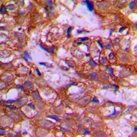 DZIP3 Antibody - Immunohistochemical analysis of DZIP3 staining in human prostate cancer formalin fixed paraffin embedded tissue section. The section was pre-treated using heat mediated antigen retrieval with sodium citrate buffer (pH 6.0). The section was then incubated with the antibody at room temperature and detected with HRP and DAB as chromogen. The section was then counterstained with hematoxylin and mounted with DPX.