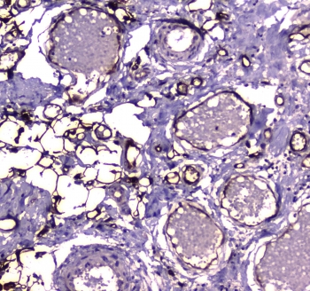 E-FABP / FABP5 Antibody - IHC testing of FFPE human lung cancer tissue with FABP5 antibody at 1ug/ml. Required HIER: steam section in pH6 citrate buffer for 20 min and allow to cool prior to staining.