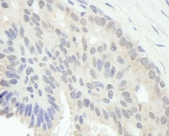 E2F1 Antibody - Detection of Human E2F1 by Immunohistochemistry. Sample: FFPE section of human breast carcinoma. Antibody: Affinity purified rabbit anti-E2F1 used at a dilution of 1:250. Epitope Retrieval Buffer-High pH (IHC-101J) was substituted for Epitope Retrieval Buffer-Reduced pH.