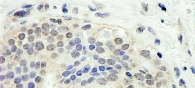 E2F1 Antibody - Detection of Human E2F1 by Immunohistochemistry. Sample: FFPE section of human breast carcinoma. Antibody: Affinity purified rabbit anti-E2F1 used at a dilution of 1:1000 (1 Detection: DAB.