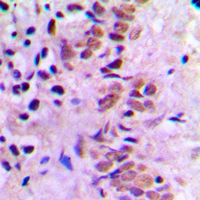 E2F1 Antibody - Immunohistochemical analysis of E2F1 staining in human breast cancer formalin fixed paraffin embedded tissue section. The section was pre-treated using heat mediated antigen retrieval with sodium citrate buffer (pH 6.0). The section was then incubated with the antibody at room temperature and detected using an HRP conjugated compact polymer system. DAB was used as the chromogen. The section was then counterstained with hematoxylin and mounted with DPX.