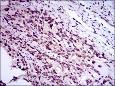 E2F1 Antibody - IHC of paraffin-embedded esophageal cancer tissues using E2F1 mouse monoclonal antibody with DAB staining.