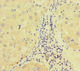 E2F1 Antibody - Immunohistochemistry of paraffin-embedded human liver cancer at dilution of 1:100