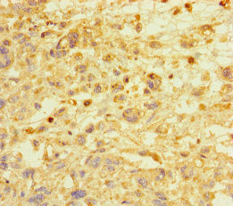 E2F1 Antibody - Immunohistochemistry of paraffin-embedded human melanoma cancer at dilution of 1:100