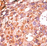 E2F1 Antibody - Formalin-fixed and paraffin-embedded human cancer tissue reacted with the primary antibody, which was peroxidase-conjugated to the secondary antibody, followed by AEC staining. This data demonstrates the use of this antibody for immunohistochemistry; clinical relevance has not been evaluated. BC = breast carcinoma; HC = hepatocarcinoma.