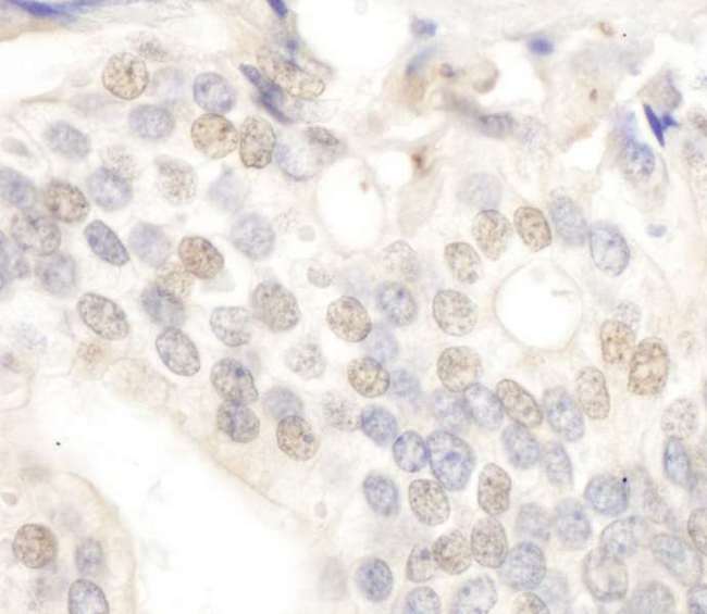 E2F4 Antibody - Detection of Human E2F4 by Immunohistochemistry. Sample: FFPE section of human prostate carcinoma. Antibody: Affinity purified rabbit anti-E2F4 used at a dilution of 1:250.