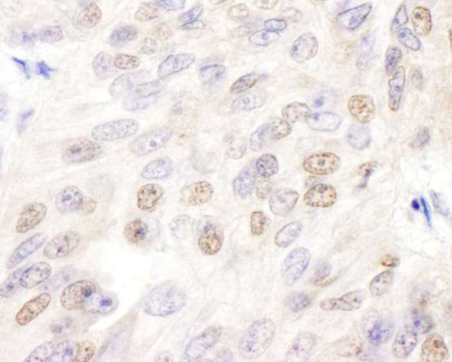 E2F4 Antibody - Detection of Human E2F4 by Immunohistochemistry. Sample: FFPE section of human breast carcinoma. Antibody: Affinity purified rabbit anti-E2F4 used at a dilution of 1:1000 (1 Detection: DAB.