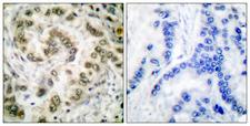 E2F4 Antibody - Immunohistochemistry analysis of paraffin-embedded human lung carcinoma tissue, using E2F4 Antibody. The picture on the right is blocked with the synthesized peptide.