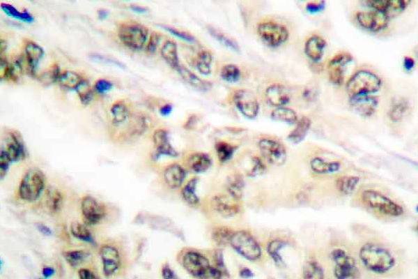 E2F4 Antibody - IHC of E2F4/E2F5 (L50/83) pAb in paraffin-embedded human lung carcinoma tissue.