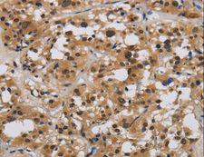 E2F4 Antibody - Immunohistochemistry of paraffin-embedded Human liver cancer using E2F4 Polyclonal Antibody at dilution of 1:40.
