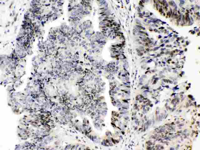 E2F4 Antibody - E2F4 was detected in paraffin-embedded sections of human intetsinal cancer tissues using rabbit anti- E2F4 Antigen Affinity purified polyclonal antibody