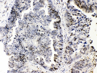 E2F4 Antibody - IHC testing of FFPE human intestinal cancer tissue with E2F4 antibody at 1ug/ml. HIER: steam section in pH6 citrate buffer for 20 min.