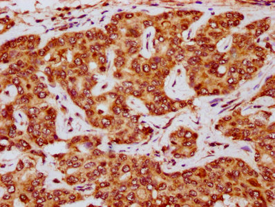 E2F5 Antibody - Immunohistochemistry Dilution at 1:200 and staining in paraffin-embedded human liver cancer performed on a Leica BondTM system. After dewaxing and hydration, antigen retrieval was mediated by high pressure in a citrate buffer (pH 6.0). Section was blocked with 10% normal Goat serum 30min at RT. Then primary antibody (1% BSA) was incubated at 4°C overnight. The primary is detected by a biotinylated Secondary antibody and visualized using an HRP conjugated SP system.