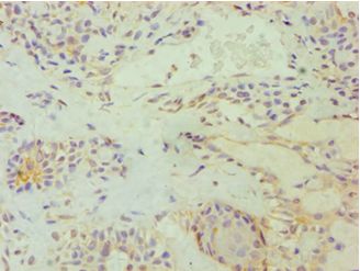 E2F6 Antibody - Immunohistochemistry of paraffin-embedded human breast cancer using antibody at 1:100 dilution.