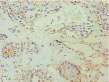 E2F6 Antibody - Immunohistochemistry of paraffin-embedded human breast cancer using antibody at 1:100 dilution.