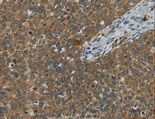 E2F6 Antibody - Immunohistochemistry of paraffin-embedded Human cervical cancer using E2F6 Polyclonal Antibody at dilution of 1:60.