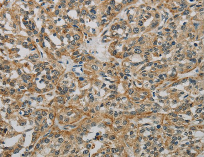 E2F6 Antibody - Immunohistochemistry of paraffin-embedded Human esophagus cancer using E2F6 Polyclonal Antibody at dilution of 1:60.