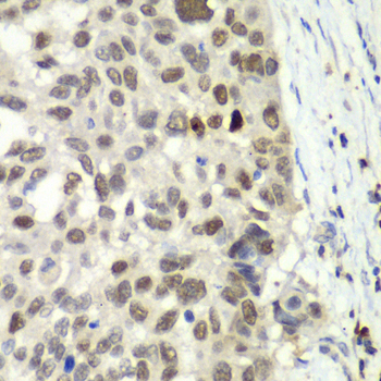 E2F6 Antibody - Immunohistochemistry of paraffin-embedded human esophageal cancer using E2F6 antibody at dilution of 1:100 (40x lens).