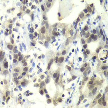 E2F6 Antibody - Immunohistochemistry of paraffin-embedded human gastric cancer using E2F6 antibody at dilution of 1:100 (40x lens).