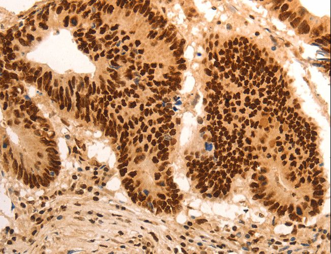 E2F7 Antibody - Immunohistochemistry of paraffin-embedded Human gastric cancer using E2F7 Polyclonal Antibody at dilution of 1:60.