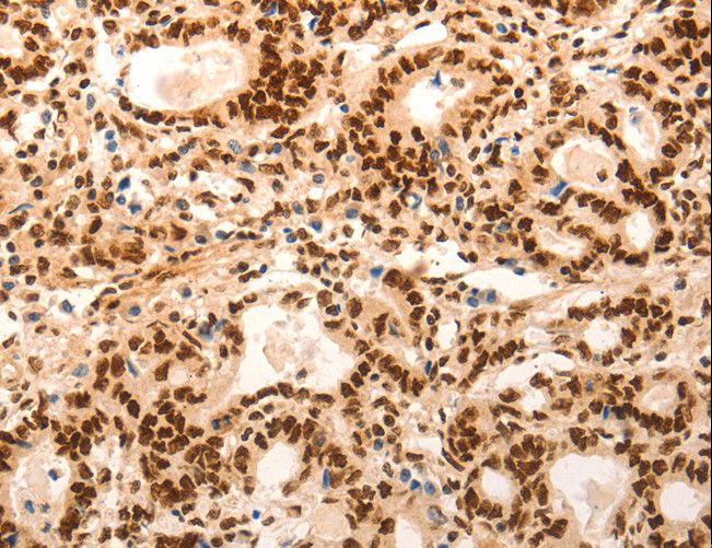 E2F7 Antibody - Immunohistochemistry of paraffin-embedded Human gastric cancer using E2F7 Polyclonal Antibody at dilution of 1:60.