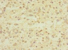 E4 / UBE4A Antibody - Immunohistochemistry of paraffin-embedded human glioma at dilution 1:100