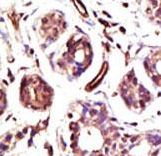 E6AP / UBE3A Antibody - Formalin-fixed and paraffin-embedded human cancer tissue reacted with the primary antibody, which was peroxidase-conjugated to the secondary antibody, followed by DAB staining. This data demonstrates the use of this antibody for immunohistochemistry; clinical relevance has not been evaluated. BC = breast carcinoma; HC = hepatocarcinoma.