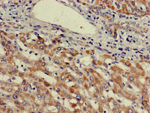 E6AP / UBE3A Antibody - Immunohistochemistry image of paraffin-embedded human liver cancer at a dilution of 1:100